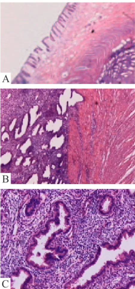 Figure  3.  (A)  Aspect  of  endometriosis.  (B)  Relation  between  endometrial  tissue  and  the  muscular  layer  of  the  appendix