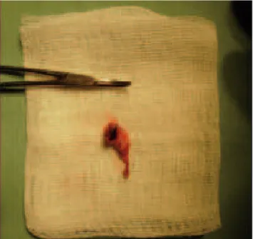 Figure 1. Hyperpigmented anal papilla at the posterior midline.
