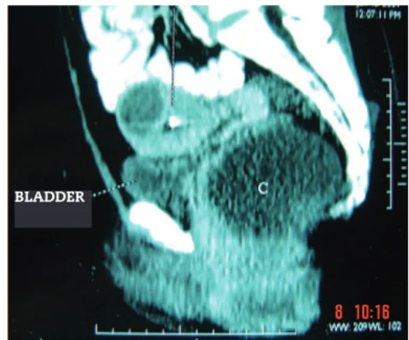 Fig. 1 - Pelvic CT (sagittal view) showing  the presence of  mass (C) in the pelvic region