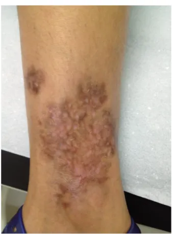Fig. 2 - After the third infusion of IFX. Ulcer is at the end  of granulation phase, still reddish in appearance, showing  almost complete epithelialization.