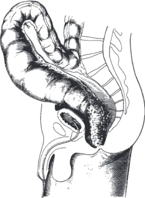 Fig. 4 - Allis clamp attached and incision of the rectal wall  begun.