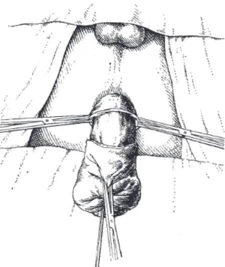Fig. 6 - Sigmoid pulled out through the anus to the level  previously marked by the stitch.