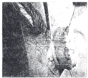 Fig. 14 - Suture begun of the mucosa of the rectum to the  mucosa of the sigmoid lexure with interrupted cotton  sutures.