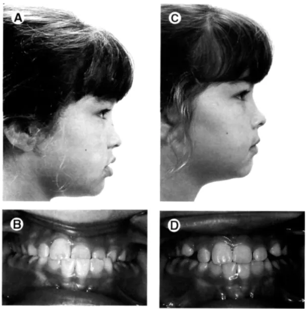 Figura 3. Pré-tratamento (A e B) fotografias de um paciente tratado com RPE e máscara de  protração; pós-tratamento (C e D) do paciente