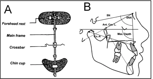 Figura 5. Componentes da máscara Petit-type (A) e mensurações cefalométricas angulares e  lineares das relações sagitais da maxila