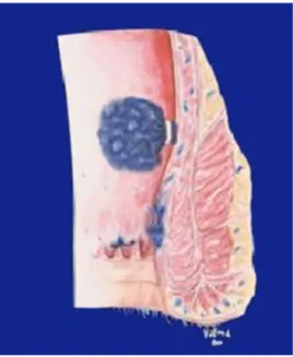Fig. 5 – Site for banding in the high macro rubber band  procedure.