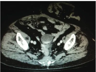 Fig. 1 – CT - sagittal view – tumor lesion aspect.