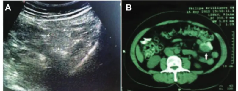 Fig. 3 – A. Abdominal USG showing hyperechoic mass with  irregular and ill-defi ned borders and peripheral acoustic  enhancement (crosses) on the sigmoid colon wall and  small central hypoechoic area (white arrow)
