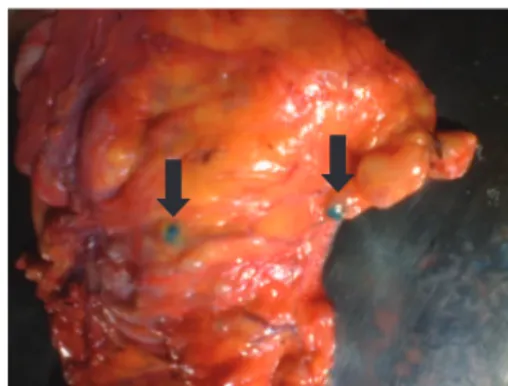 Fig. 2 – Intestinal mesentery with visual identifi cation of  sentinel lymph nodes using patent blue dye.
