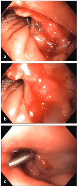 Fig. 1 – Pouch anastomotic bleeding: (a) before, (b) after the  removal of the staples, and (c) one endoclip was deployed