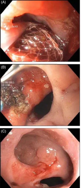 Fig. 1 – Successful endoscopic treatment of fecalith blocking sinus in a patient with an ileal pouch