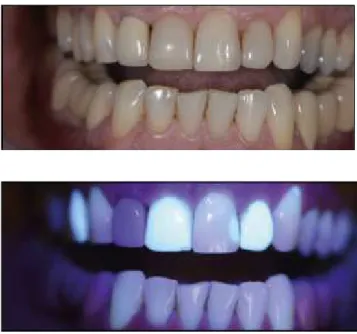 Figura 4A e 4B. Fluorescência dentária e em diferentes tipos de restaurações (Adaptado Soares P.V  2017 