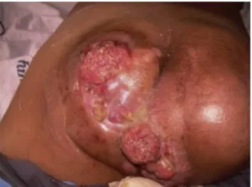 Fig. 1 – Perianal tumors with areas of mucopurulent discharge and a characteristic odor, associated with anal fistulas and vegetating, friable lesions.