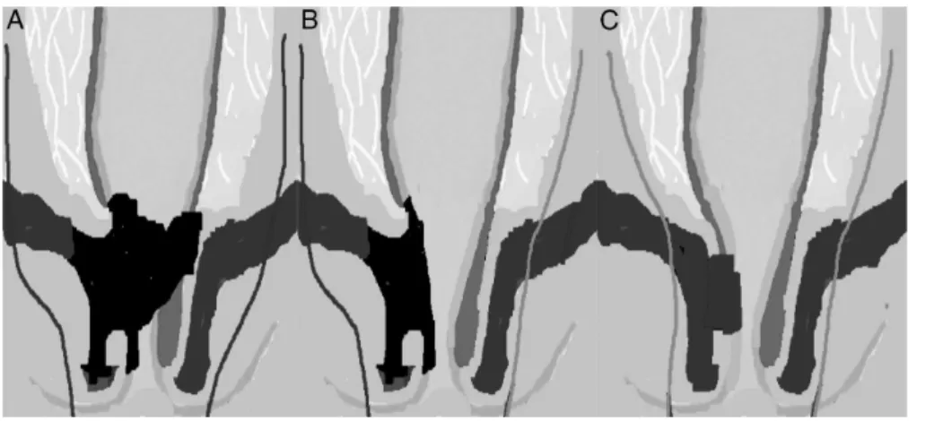 Fig. 10 – Individual cylindrical APR technique according to Han and colleagues. (A) Bilateral extralevator APR