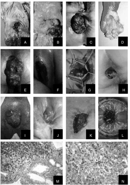 Fig. 1 – Illustrations of the 14 patients with ARMs: four surgical specimens of abdominoperineal resection (patients A, B, C and D), five patients submitted to local resection (patients E*, F, G, I, L), one with protective stoma (patient E*), one to extend