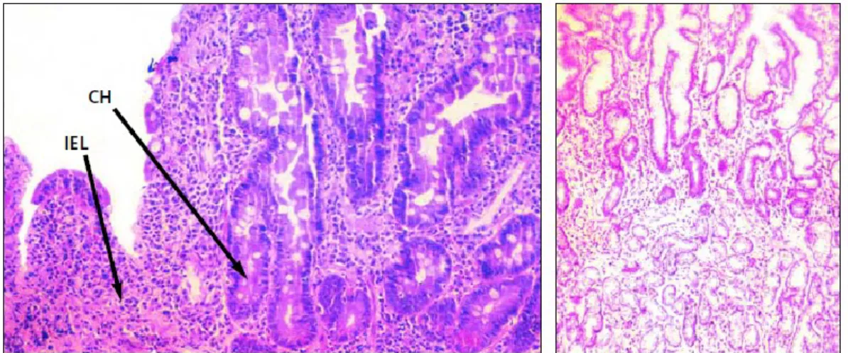 Figura 2 - (Esquerda) Biópsia da porção duodenal distal de um doente celíaco: de notar a hiperplasia das  criptas (CH) e o número elevado de linfócitos intraepiteliais (IEL)