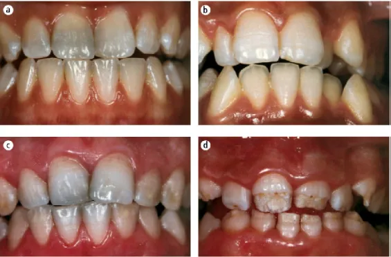 Figura 7 - Os defeitos do esmalte dentário, segundo a classificação de Aine: grau I (a), grau II  (b), grau III (c) e grau IV (d)