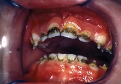 Figura 8 - Descoloração dentária extrínseca peculiar ao longo do terço cervical dos dentes