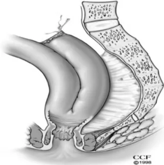 Fig. 1 – Leak at the tip of the J-pouch.