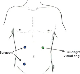Fig. 1 – Position of the trocars in Duhamel surgery by 