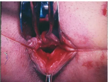 Fig. 4 – A, The distended loop, to be desiccated, exposed in  the perineum. The loop came down the rectorectal space  and traversed the area between the rectal mucosa and the  internal sphincter