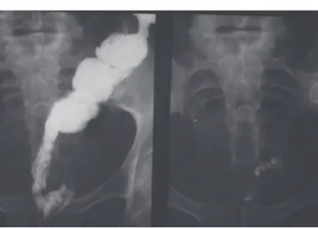 Fig. 8 – Intestinal transit performed after Duhamel  operation in a patient with acquired megacolon