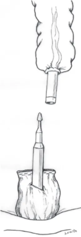 Fig. 9 – Schematic representation of the posterior colorectal  anastomosis.