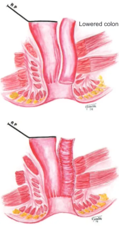 Fig. 10 – Schematic representation of the colon-rectum-anal  anastomosis. A, The lowered colon goes down the retrorectal  space to the channel and then through the dissected tunnel  between the rectal mucosa and internal sphincter