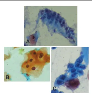 Fig. 2 – A, Columnar cells from the anal transformation  zone. B, Low-grade anal intraepithelial lesion