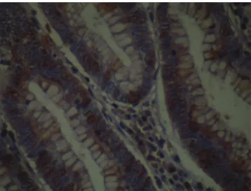 Fig. 4 – Photomicrograph of colorectal adenoma with  positive immunoexpression for the TCF4 antibody,  represented by a brownish colour in the cell nucleus  (immunohistochemistry ×200) (photo by the author).