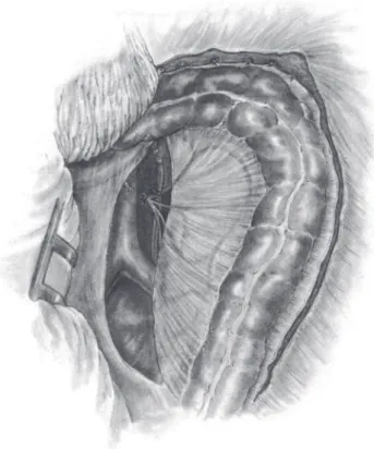 Fig. 3 – Illustration of the circumferential incision of the  rectal wall allowing access to the intersphincteric plane.