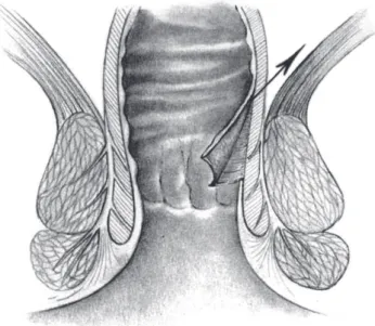 Fig. 5 – Perineal colostomy created through exteriorization  of a segment of well-vascularized and tension- free  proximal colon.