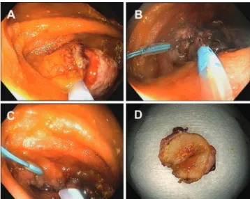 Fig. 1 – Endoscopic needle knife-assisted polypectomy in hot  snare-resistant ibrotic inlammatory polyp (Case 1)