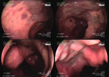 Fig. 3 – Embolization of left and right hipogastric vessels  prior to surgery.