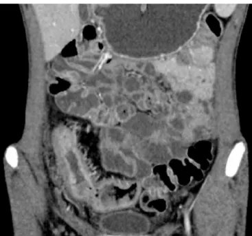Fig. 1 – Enterography by computed tomography of abdomen (sagittal section) showing luminal dilation, wall thickening and contrast hyper-uptake.