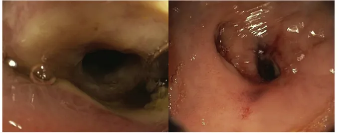 Fig. 2 – Flexible Sigmoidoscopy showing a severely narrowed stricture near upper rectum.