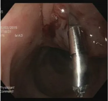 Fig. 1 – Perforated colon after polypectomy.