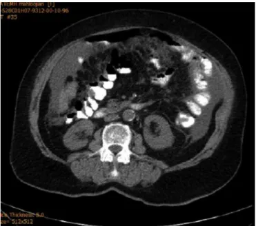 Fig. 4 – Absence of contrast agent leakage in follow-up CT scan.