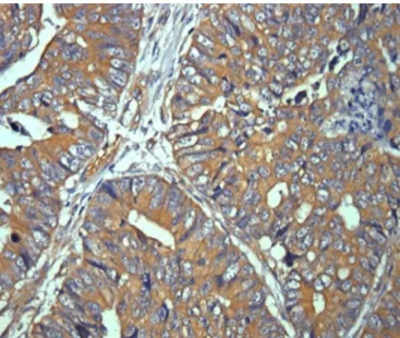 Fig. 2 – Photomicrograph of colorectal carcinoma with positive immunoreactivity antibody axin in the cytoplasm of tumor cells (immunohistochemistry; 100 × ).