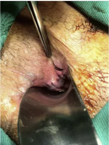 Fig. 2 – Transoperatory demonstrating posterolateral sinus containing hair in its interior.