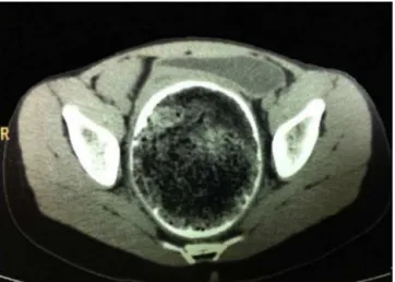 Fig. 2 – Computed tomography (coronal plane) showing rectal fecal impaction with megarectum.