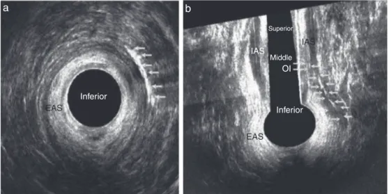 Fig. 3 – Transsphincteric fistula in a female patient after application of hydrogen peroxide