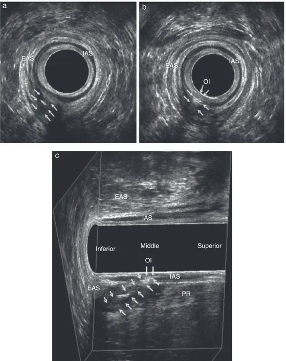 Fig. 4 – Transsphincteric fistula in a male patient after application of hydrogen peroxide