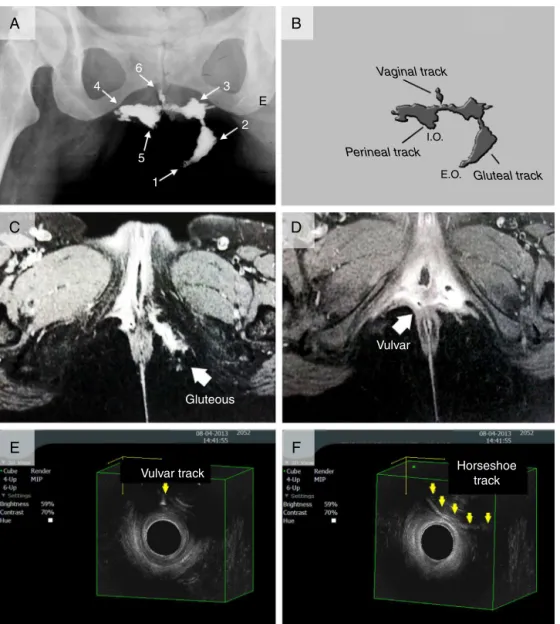 Fig. 1 – Fistulography images of horseshoe track in antero-posterior fistulography (A) showing left gluteal external orifices [1,2], left horseshoe track communicating left ischiorectal fossa track and hole [3], right horseshoe track next to levator ani, w