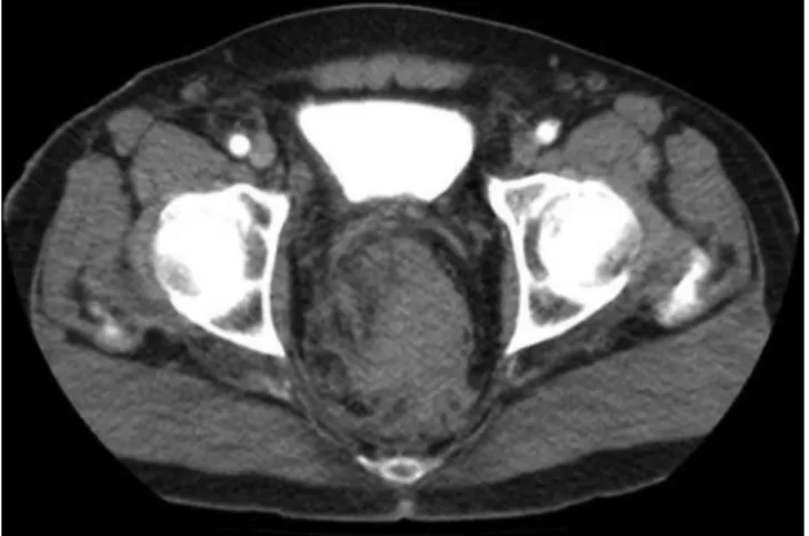 Fig. 1 – Pelvic CT scan without rectal contrast, showing an important rectal thickening with rectal wall blurring and perirectal fat compatible with pelvic hematoma