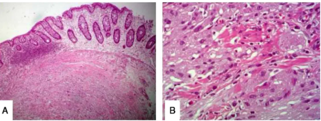 Fig. 1 – (A) Histologic overview of the lesion. (B) Detail of the histology.