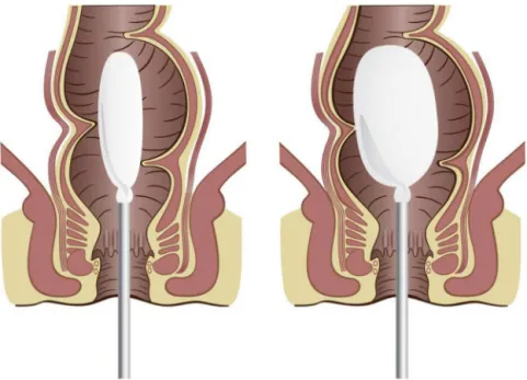 Fig. 1 – Simulation of anorectal manometry examination with and without the rectal balloon deflated.