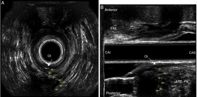 Fig. 2 – Presence of an internal fistulous opening at 6 o’clock position (white arrow) in the middle anal canal, suggesting the presence of an anal fistula (yellow arrows)