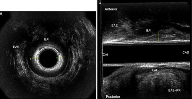 Fig. 3 – Increase in the thickness of the subepithelial tissue (mucosal prolapse) in middle (MAC) and upper (UAC) anal canal.