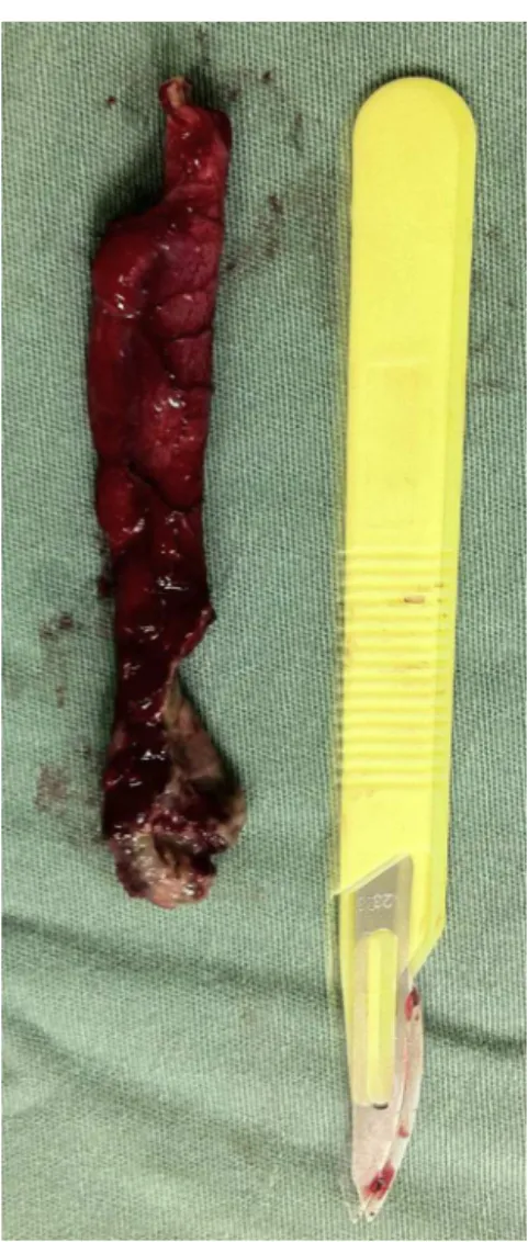 Fig. 4 – Appendix and foreign bodies.